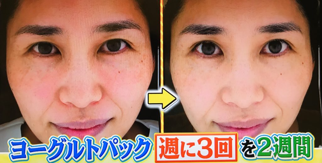 世界一受けたい授業で放映 夏の紫外線ダメージを今すぐケア シミ 世界一受けたい授業で放映 夏の紫外線ダメージを今すぐケア シミ